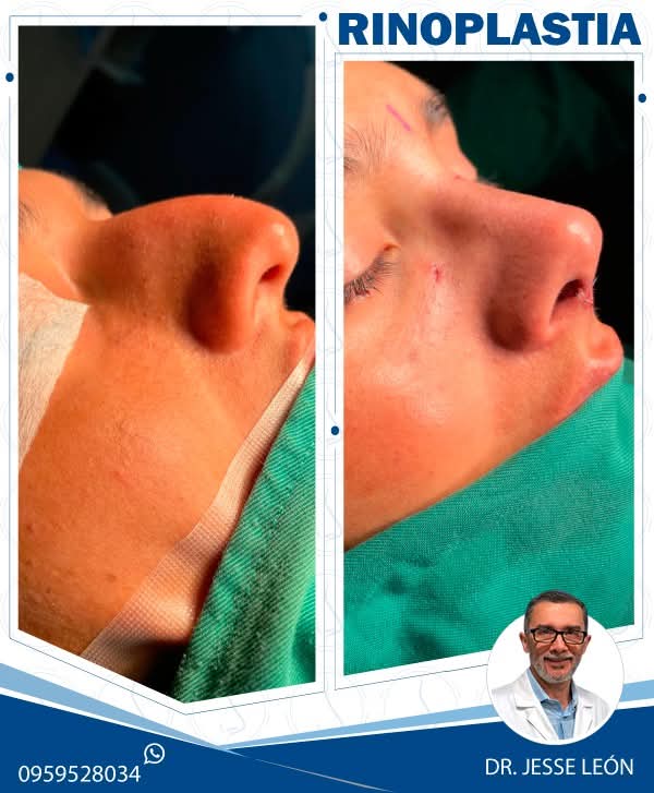 Rinoplastia antes y después